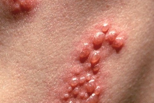 Nhiễm Herpes simplex