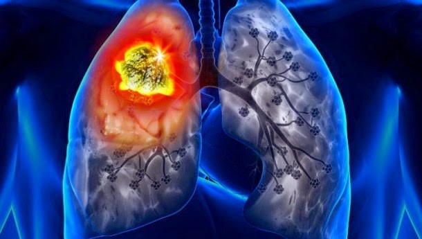 Bụi phổi atbet (amiăng)