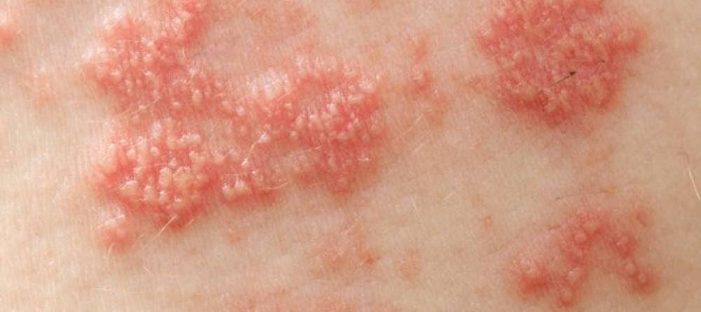 Nhiễm Herpes zoster