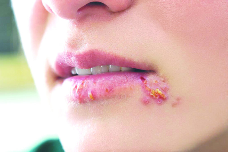 Herpes môi