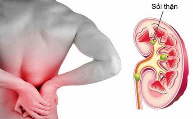 Sỏi mật, sỏi thận khiến bạn đau đớn mỗi ngày?